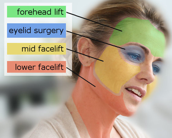 Types_of_Facelift
