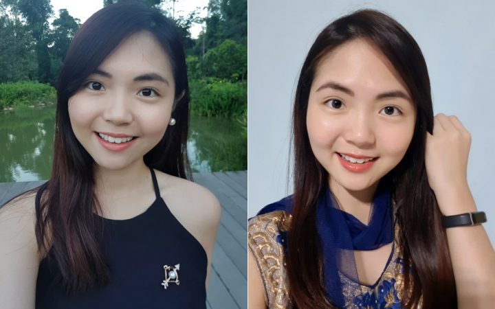 Botox smile results